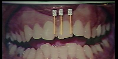 Pôster de Queime, Bundy, Queime